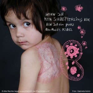 7. Dezember Tag des brandverletzten Kindes