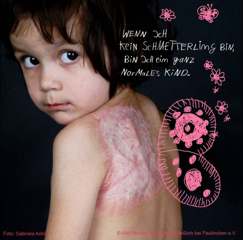 Tag des brandverletzten Kindes